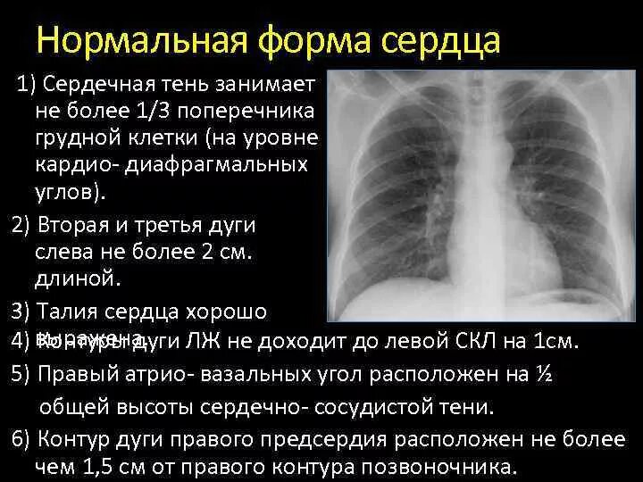 Форма средостения на рентгене. Нормальная конфигурация сердца рентген. Рентген грудной клетки норма. Тень сердца на рентгенограмме в норме. Границы расширены влево