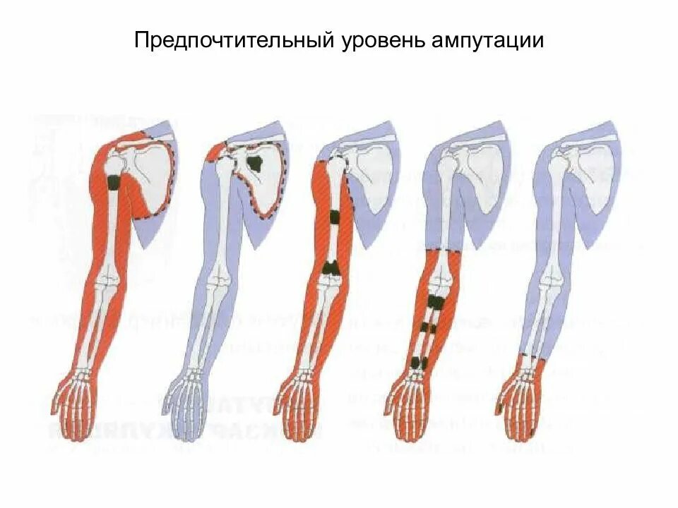 Ампутация предплечья в средней трети. Ампутация верхней конечности. Уровни ампутации верхней конечности.