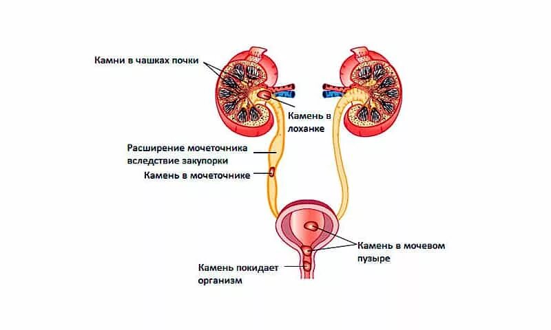 Мочеточник у мужчин лечение. Почечные чашки лоханка мочеточники. Чашечка мочеточника. 1/3 Мочеточника. Почки и мочевой.