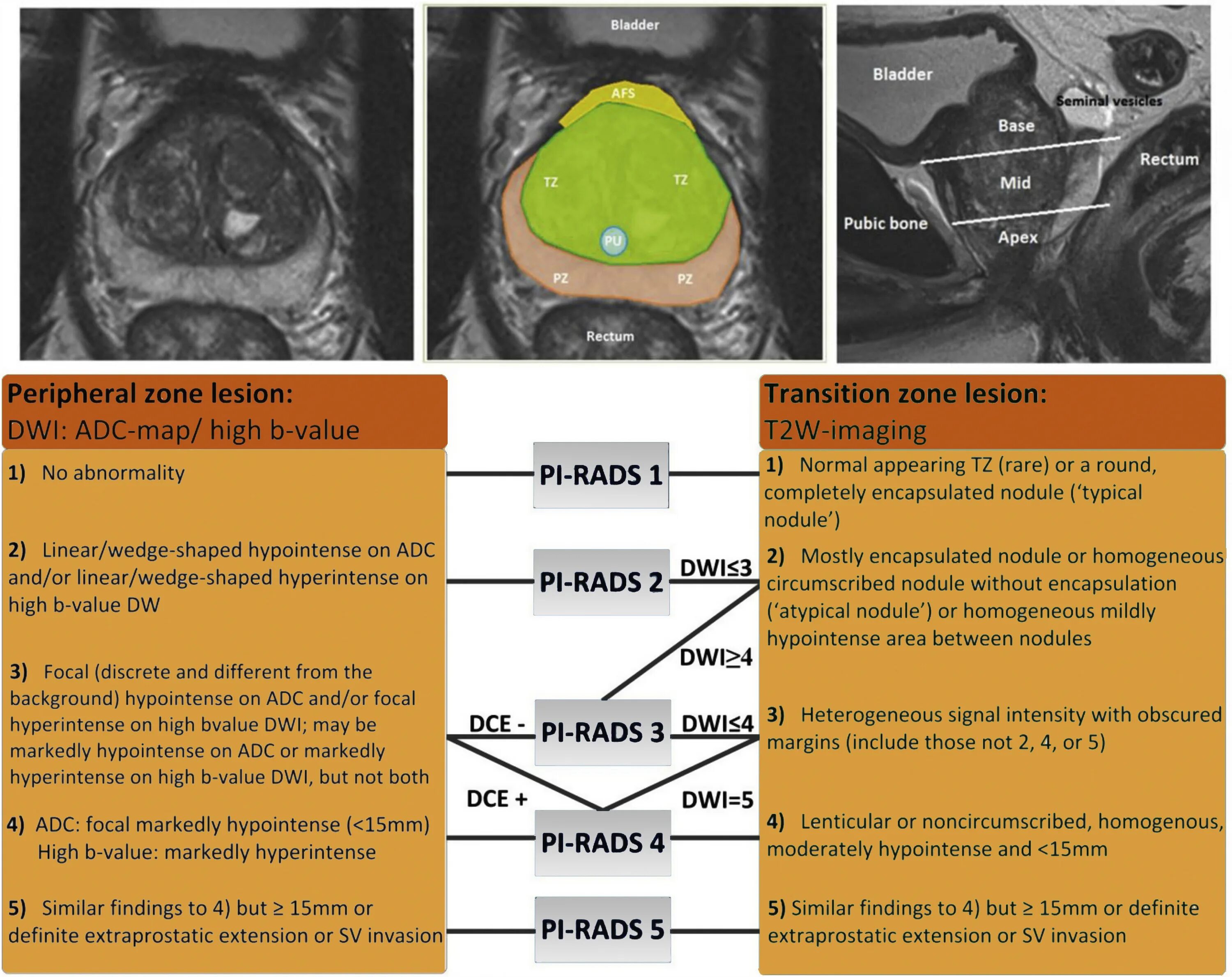Rads 4 предстательной железы. Pi-rads 2 предстательной железы. Pirads мрт предстательной железы. Pi-rads классификация. Зоны предстательной железы по Pirads.
