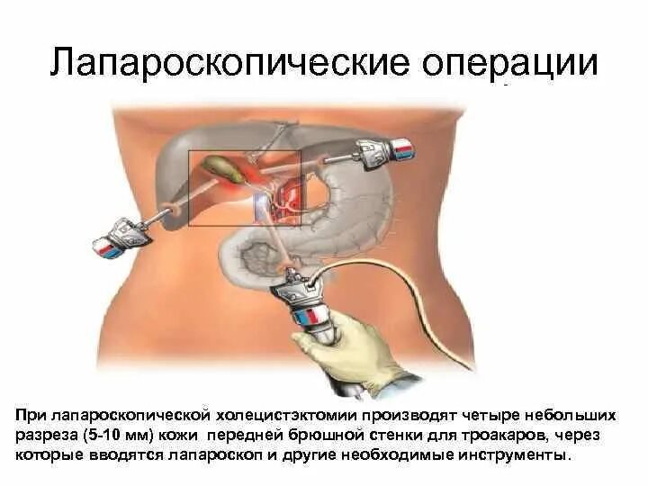 После удаления желчного пузыря