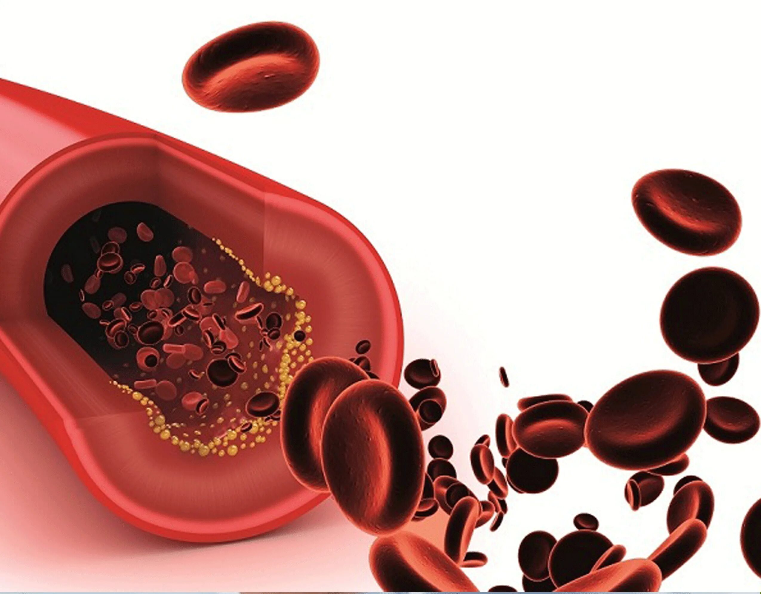 Гиперхолестеринемия. Школа холестерина cholesterol.