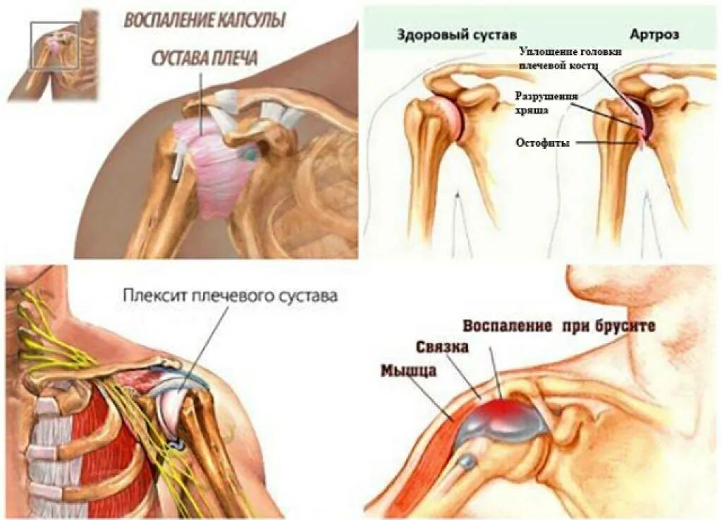 Плечелопаточный периартрит плечевого сустава. Хруст в целевом суставе. Плечо и плечевой сустав. Сильно болят плечи причина