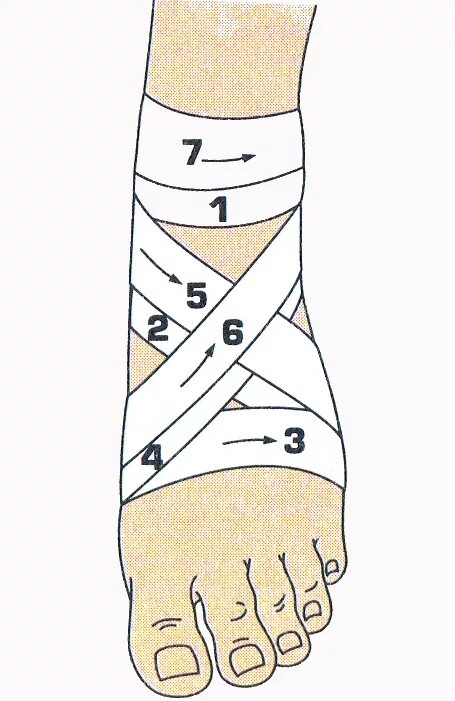 Перевязка голеностопа эластичным бинтом. Восьмиобразная повязка эластичным бинтом. Бинтовать голеностоп эластичным бинтом. Бинтование голеностопа эластичным бинтом. Как перебинтовать эластичным