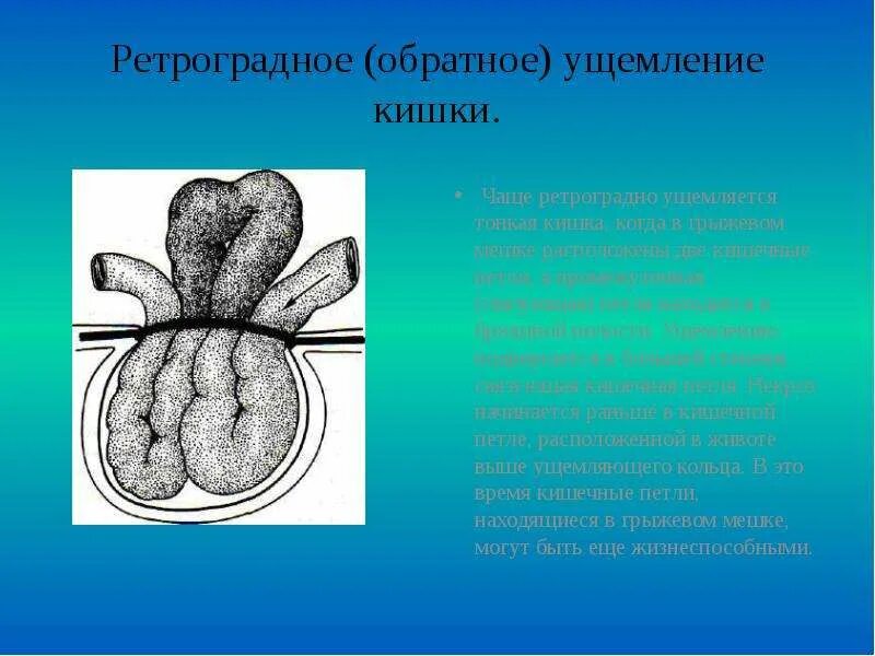 Ретроградное ущемление петли тонкого кишечника. Ретроградное ущемление кишки в грыже. Ретроградная ущемленная грыжа. Паховая грыжа ретроградное ущемление.