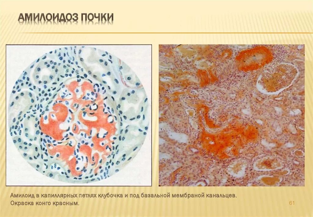 Саговая селезенка. Амилоидоз почек окраска Конго. Амилоидоз препарат патанатомия. Амилоидоз почки микропрепарат. Амилоидоз почки макропрепарат Конго красный.