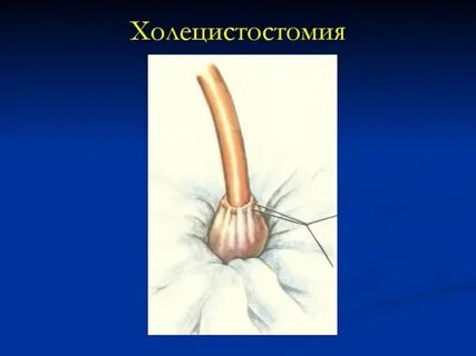 Холецистостомия операция