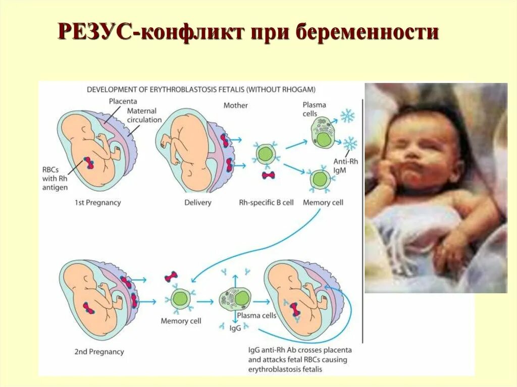 Резус фактор у беременных. Последовательность стадий развития резус- конфликта. Иммунологическая основа резус-конфликта. Резус-конфликт гистология. Резус конфликт беременность.