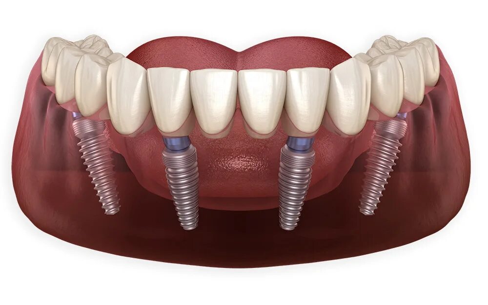 Несъемный протез на 4 имплантах Осстем. Аллон 4 протезирование. Имплантаты Dentium Superline.