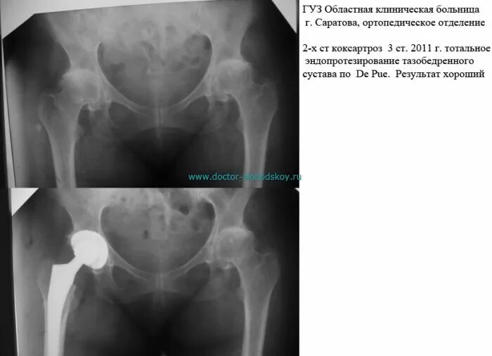 Коксартроз тазобедренного инвалидность положена. Коксартроз эндопротезирование тазобедренного сустава. коксартроз тазобедренного сустава операция. коксартроз тазобедренного 3ст операции. эндопротез тазобедренный сустав рентген дисплазия.