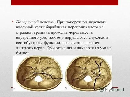 Симптомы продольного перелома височной кости