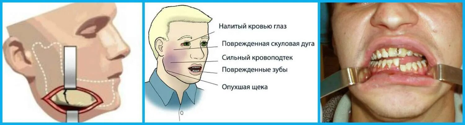 Принят с повреждениями. Перелом челюсти симптомы. Открытый перелом нижней челюсти.