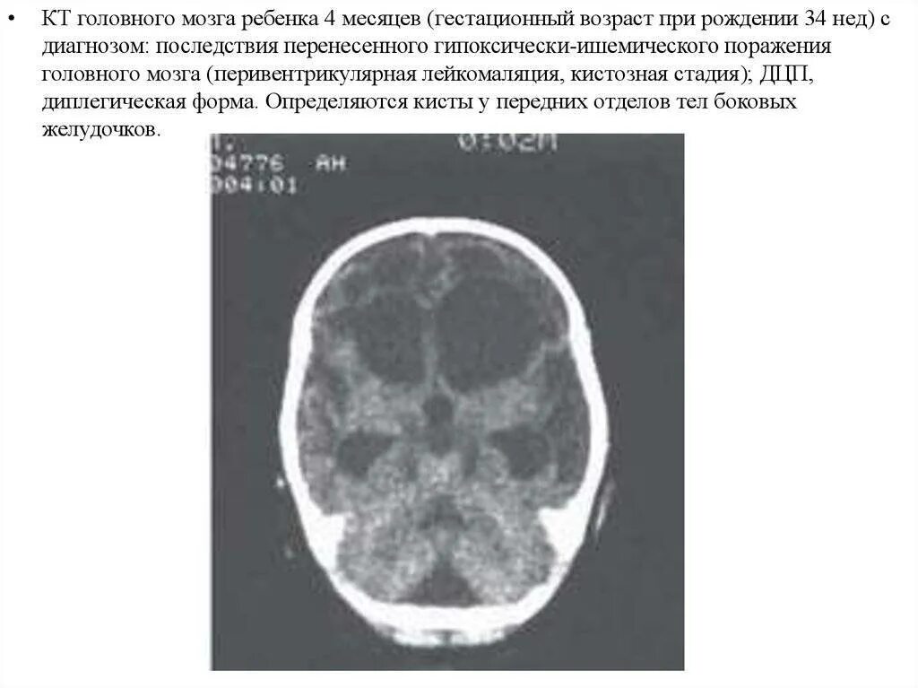Поражение мозга у новорожденных. Перивентрикулярная лейкомаляция кт. Гипоксически-ишемическое поражение головного мозга кт. Кт головного мозга при ДЦП. Гидроцефалия головного мозга мрт.