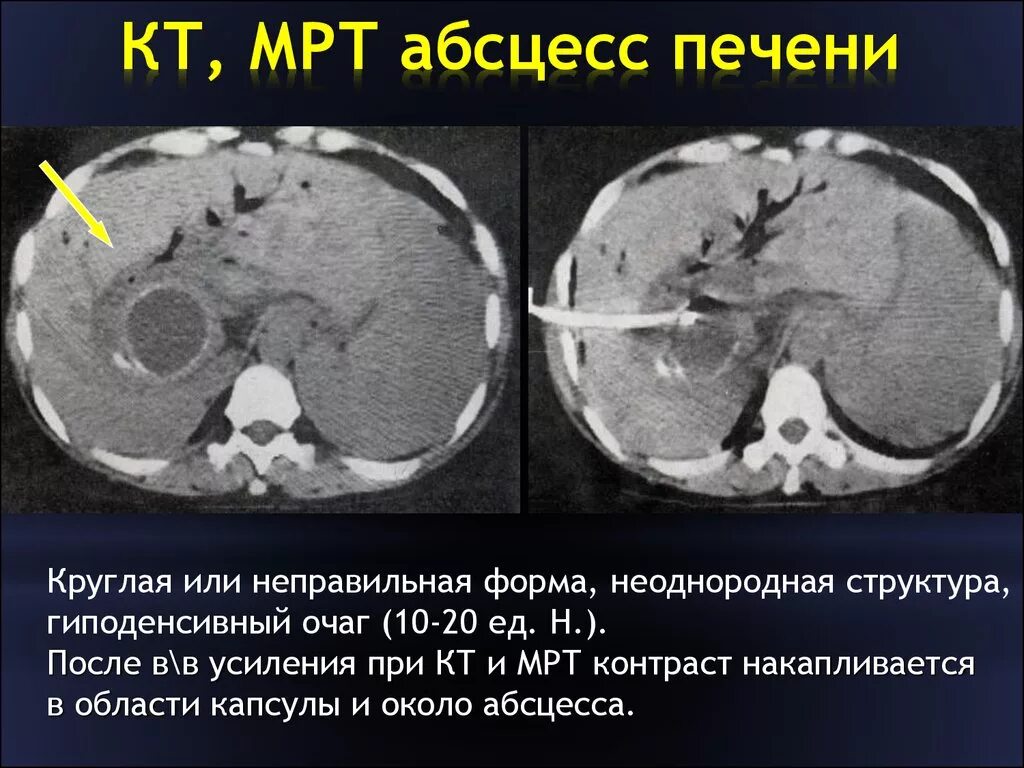 Гиперденсивный очаг в печени кт. Абсцессы печени на кт с контрастированием. Гиподенсный очаг печени кт. Гиподенсивное образование в печени