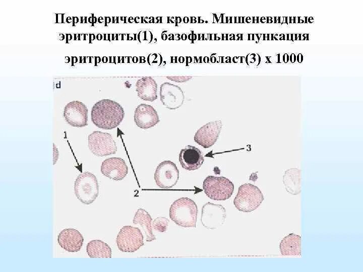 Эритроциты образуют ложноножки. Эритроциты периферической крови. мишеневидные эритроциты. появление мишеневидных эритроцитов характерно для. мишеневидность эритроцитов.