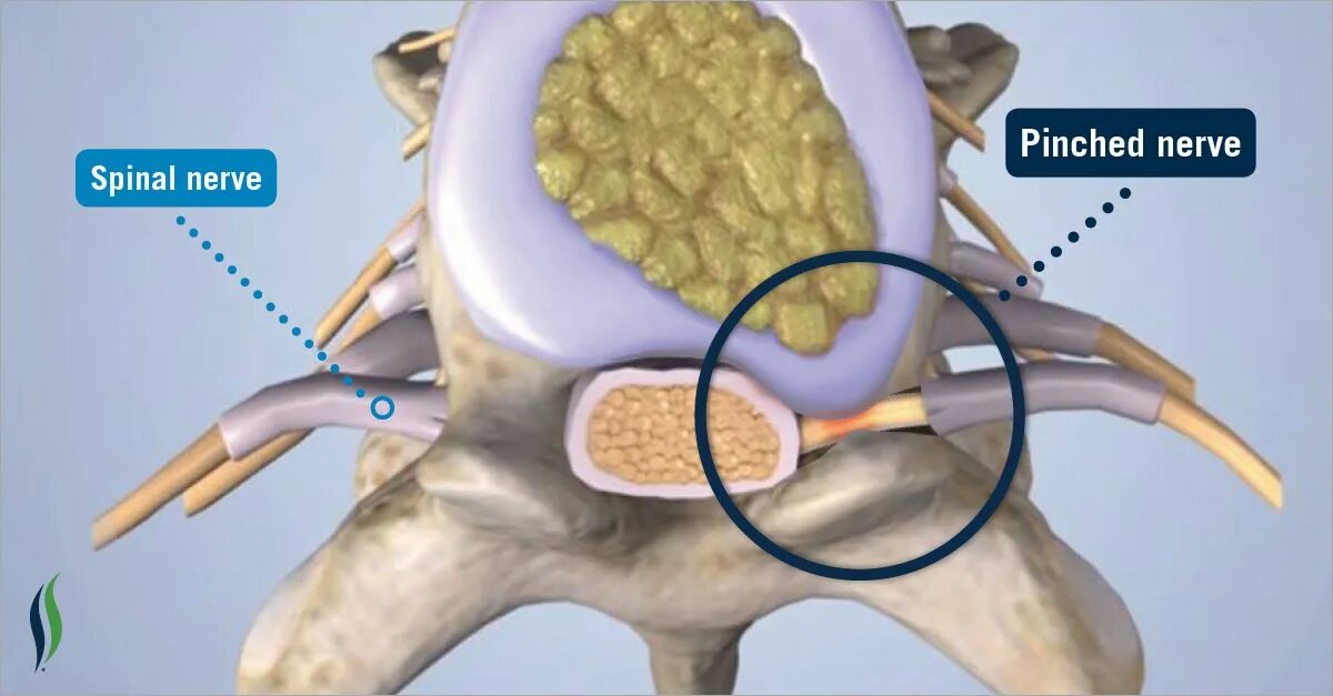 Корешковое защемление в пояснице. Грыжа позвоночника защемление нерва. Зазимоннин неова в позвоночнике. Защемило нерв в позвоночнике. Защемление нерва в позвонке.