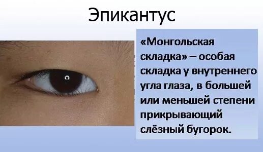Эпикантус монгольская складка. Монголоидная складка верхнего века. Люди с эпикантусом. Эпикантус признак. Складка кожи у внутреннего угла глаза.