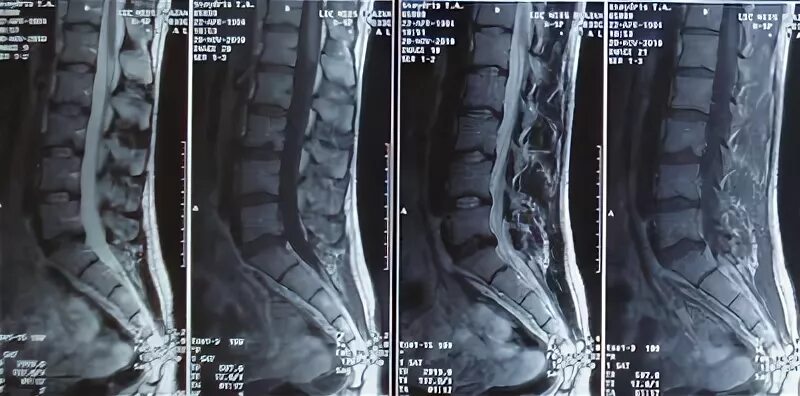 Болит поясница киста. Смещение позвонка мрт позвоночника. Мрт пояснично-крестцово-копчикового отдела позвоночника. Смещение позвонков поясничного отдела мрт. Копчиковая грыжа позвоночника.