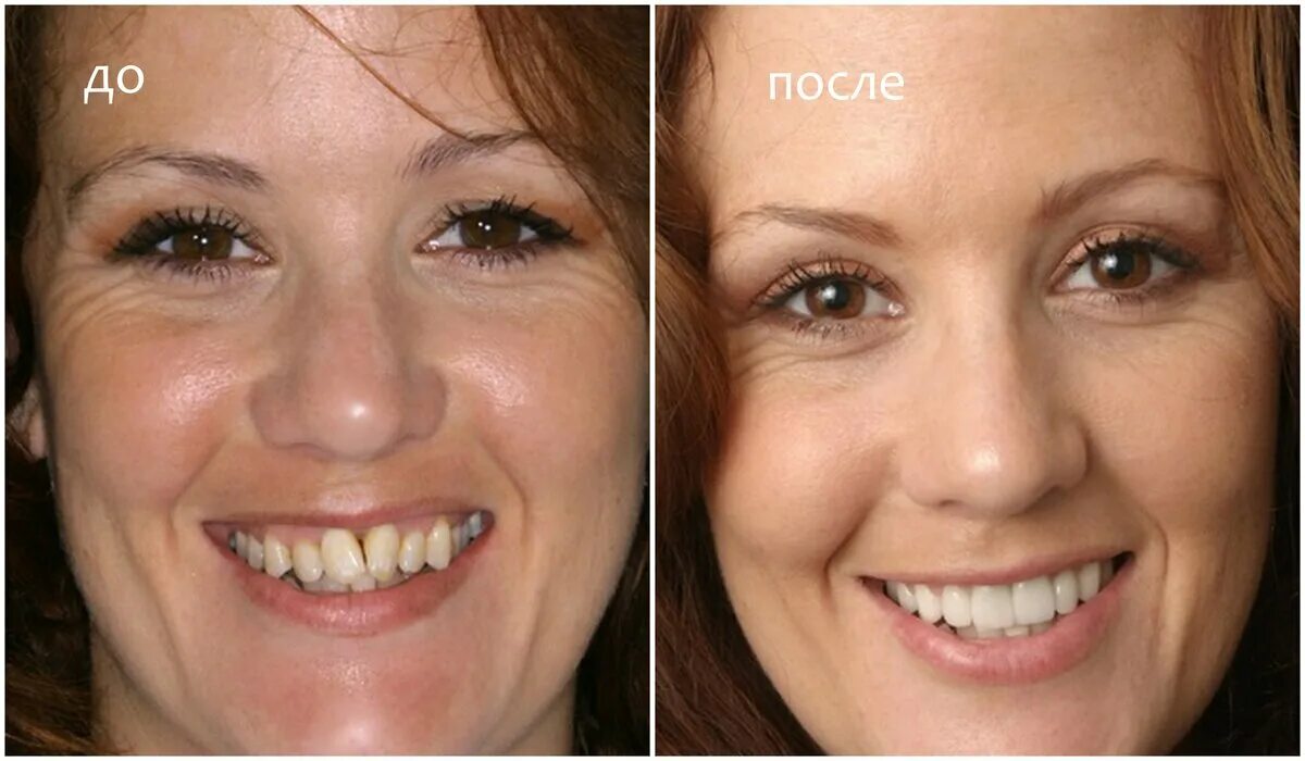 Выпрямление кривых зубов. Исправление зубов брекетами. Исправление дистального прикуса. Можно ли исправить два. Исправление кривых зубов до и после.