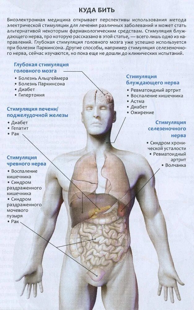 Стимулятор блуждающего нерва. Электрическая стимуляция блуждающего нерва. Стимуляция блуждающего нерва при эпилепсии. Стимулятор блуждающего нерва при эпилепсии. При стимуляции блуждающего нерва.