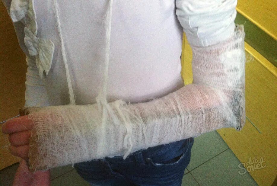 Гипс налаживает сломанный руку. Гипс налаживает сломанный руку