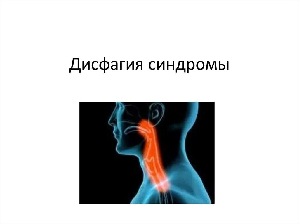 Дисфагия пищевода лечение у взрослых. Синдром дисфагии. Синдром нарушения глотания. Дисфагия презентация. Дисфагия неврология.