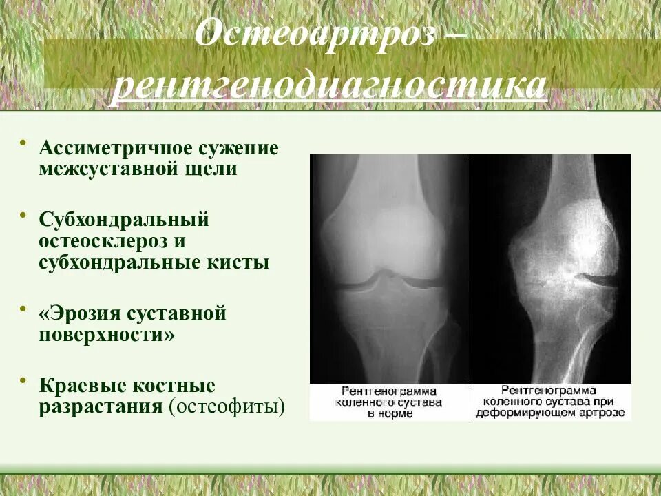 Как лечить остеосклероз. Субхондральный остеосклероз коленного сустава. субхондральный остеосклероз таз. остеосклероз схема. субхондрально расположенные кисты.