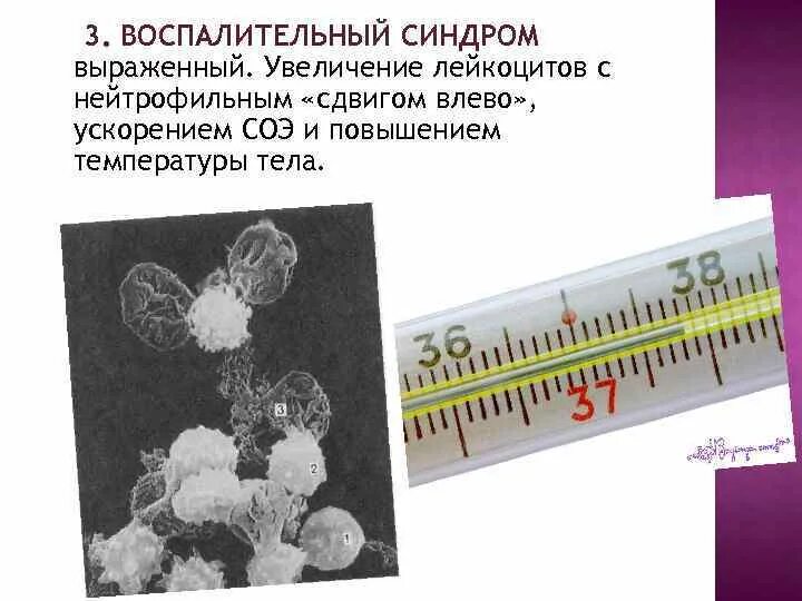 Синдром соэ. Синдром ускоренной СОЭ. Ускорение СОЭ. Синдром ленивых лейкоцитов. Ускорение СОЭ наблюдается при.