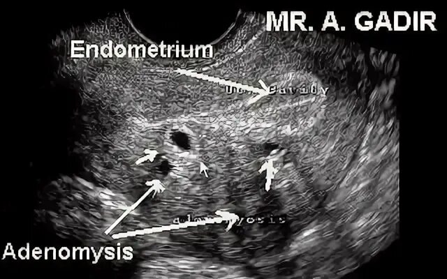 УЗИ картина аденомиоз матки. Эндометриома УЗИ картина. Эндометриоз виден на узи
