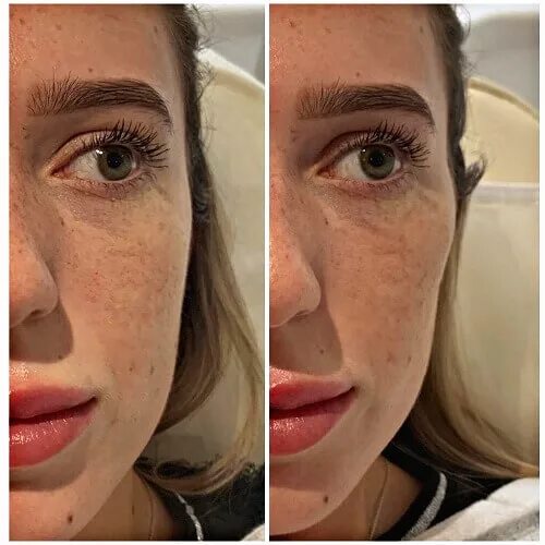 Пластика до и после отзывы Non Surgical Cheek Enhancement to improve lost volume in the apple of the cheek