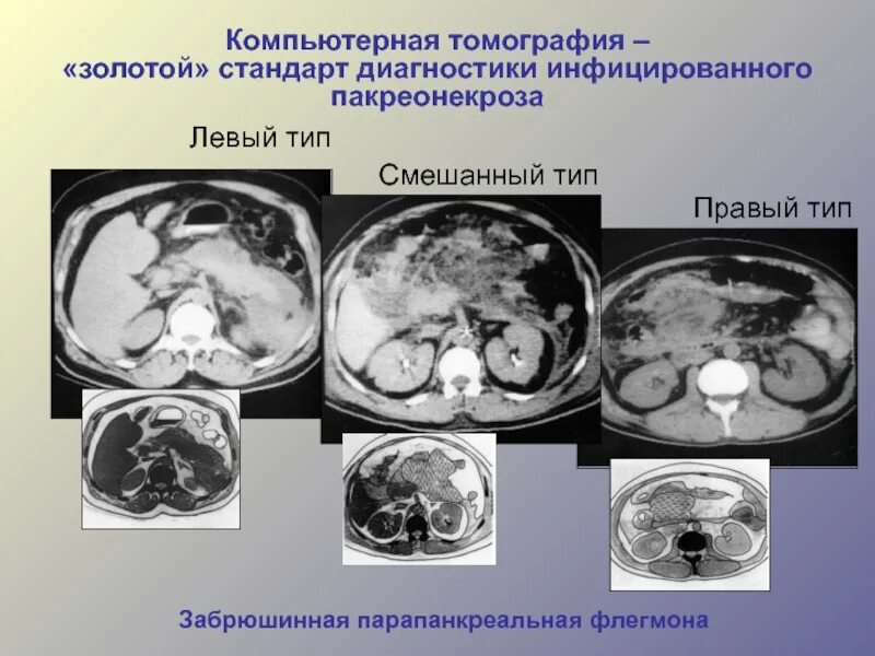 Перитонит диагностика. Перитонит на кт брюшной полости. Абсцесс брюшной полости на кт. Межпетельный абсцесс кт.