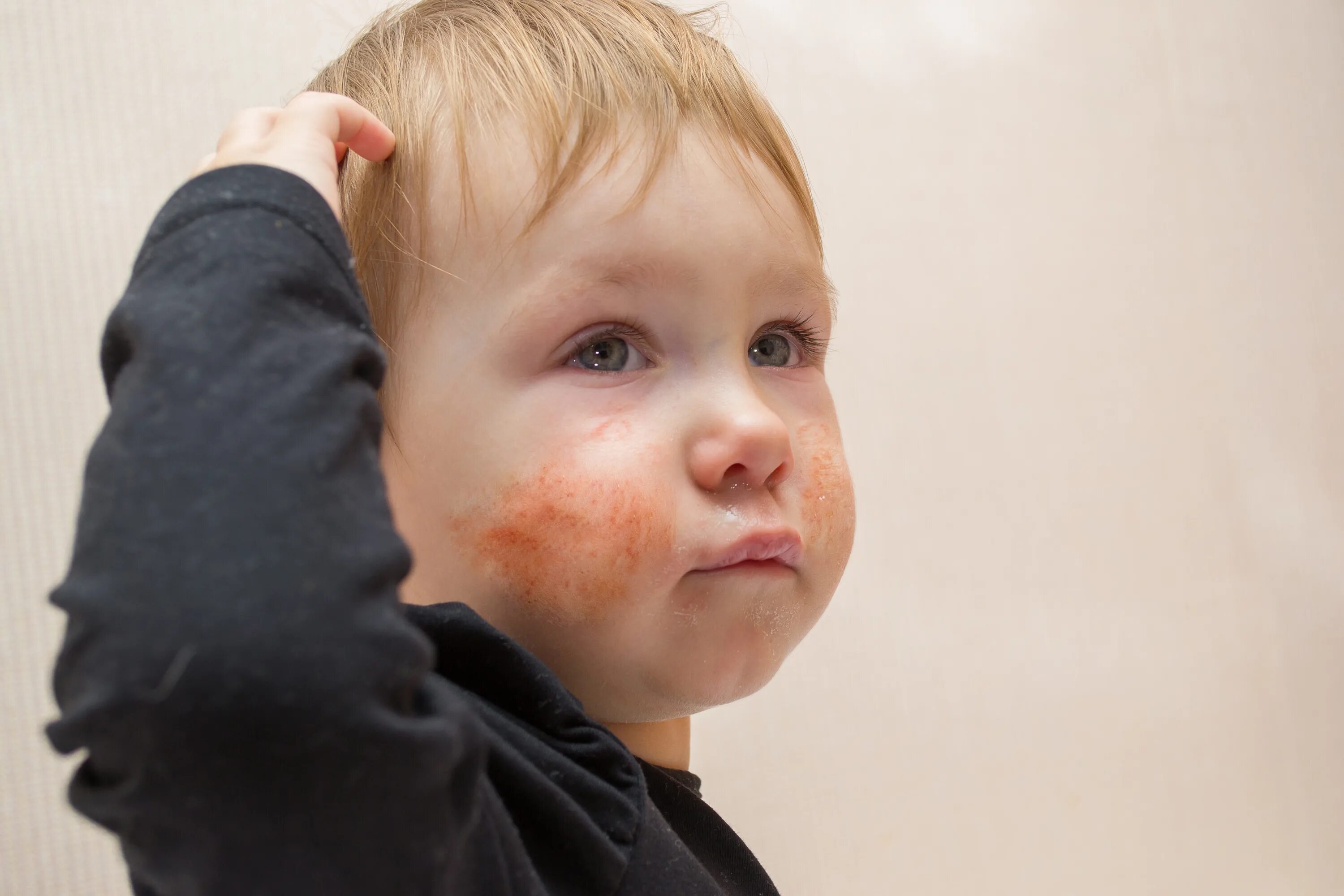 Детский кожный. Аллергические диатезы у детей. Атопический дерматит на лице у ребенка. Атопический дерматит на щеках у ребенка.