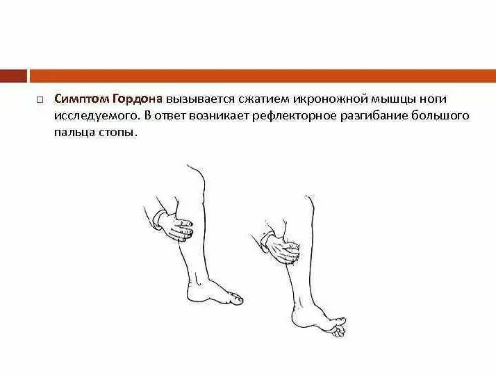 Патологический рефлекс Гордона. Метод Гордона. Система Гордона тест. Патологический рефлекс Гордона определяется.