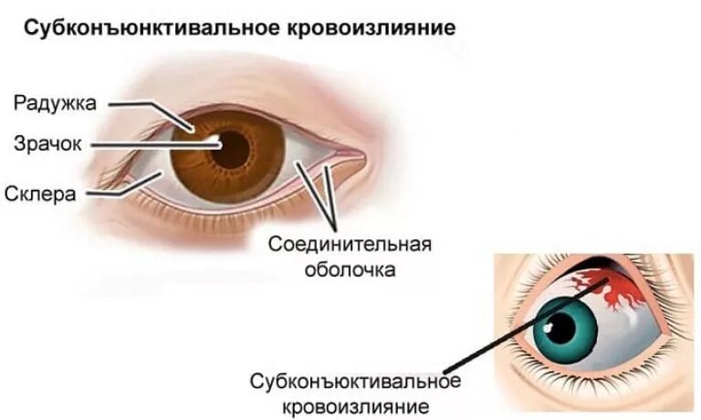 Глаза давят внутри. Подконъюнктивальный разрыв склеры. Кровоизлияние в склеру глаза. Субконъюнктивальное кровоизлияние в глазу.