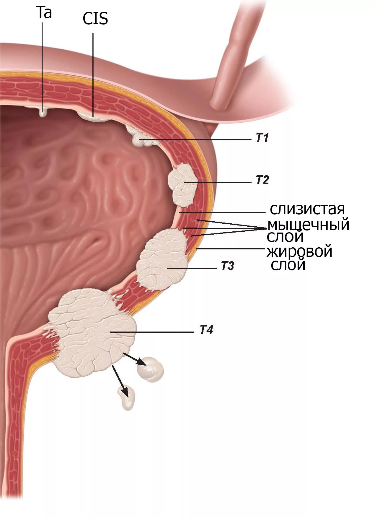 Паравезикальная клетчатка. Злокачественные новообразования мочевого пузыря. Злокачественное образование мочевого пузыря!. Опухоли мочевогоп пузыря.