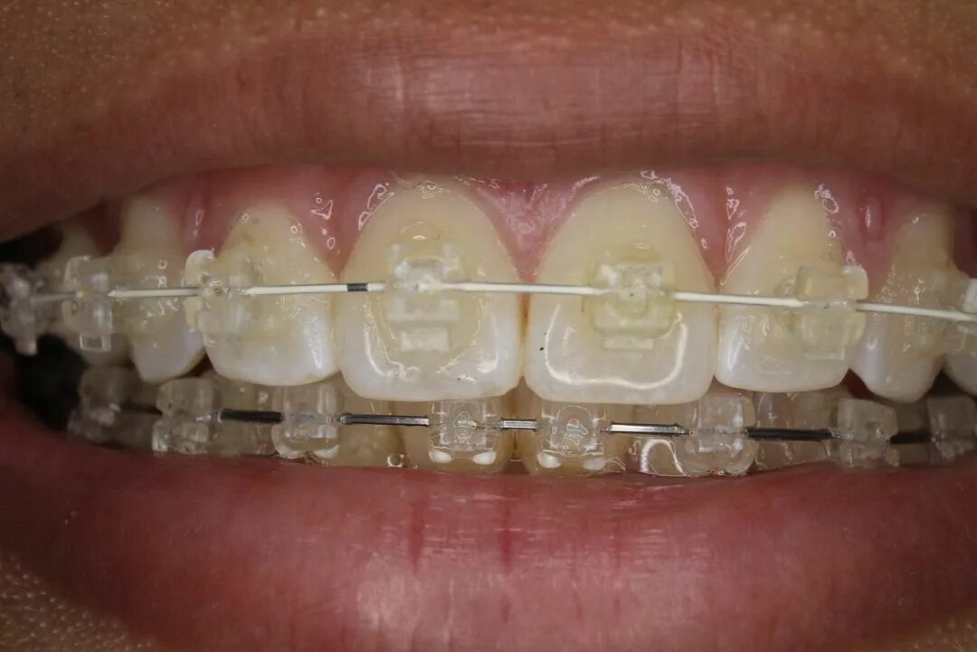 Cuanto tiempo se usan los retenedores dentales