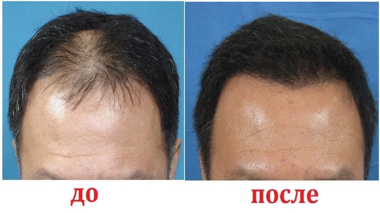 Волосы на лбу. Андрогенная алопеция миноксидил. Мезотерапия для волос до и после мужчины.