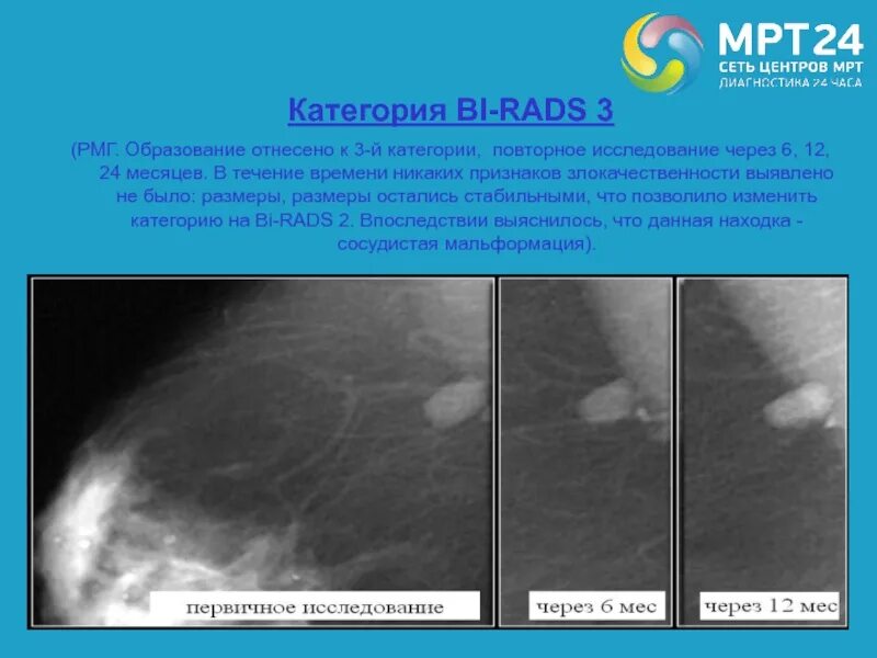 Что значит birads 3. Что такое bi rads 3 на маммографии. заключение узи молочных желез bi-rads. фиброзно кистозная мастопатия молочной железы bi-rads-4a. birads 3 молочной железы что это такое на маммографии.