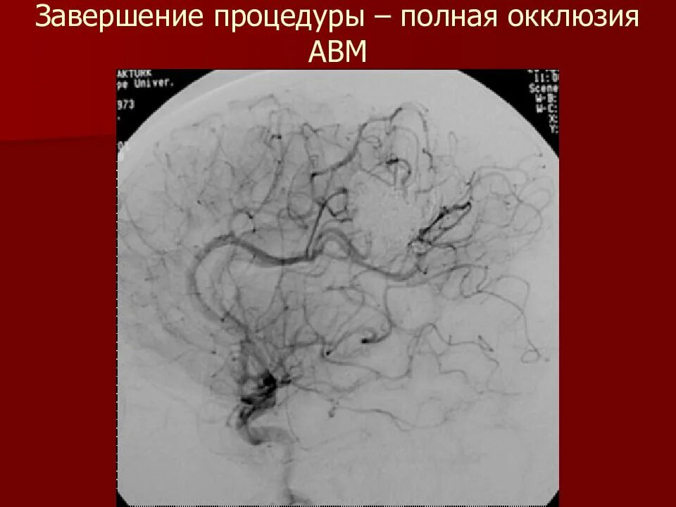 Мальформация сосудов. Артериовенозная мальформация (авм). эмболизация артериовенозной мальформации. артерия венозная мальформация. артериовенозная мальформация мскт.