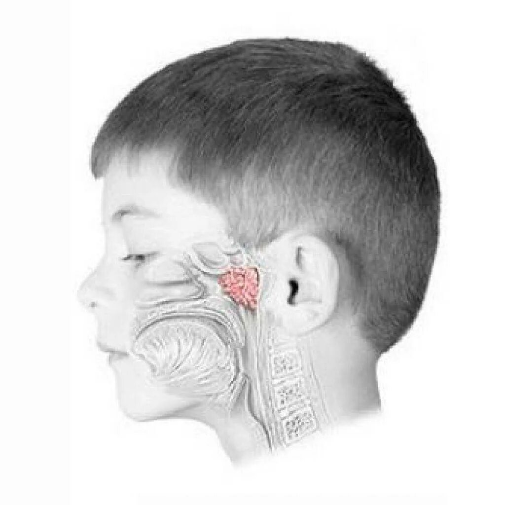 Лор органы у детей. Что такое аденоиды в носоглотке у ребенка. Аденоиды у детей симптомы.