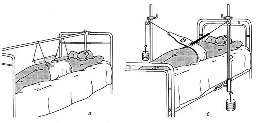 Скелетное вытяжение костей таза. Переломы костей таза скелетное вытяжение. Перелом таза вытяжение. Скелетное вытяжение при переломе таза.