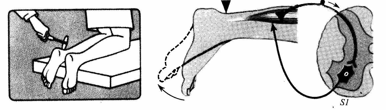 Рефлекс ахиллова сухожилия. Ахиллов рефлекс схема. Исследование рефлекса Ахиллов рефлекс. Схема рефлекторной дуги ахиллова рефлекса: 1..
