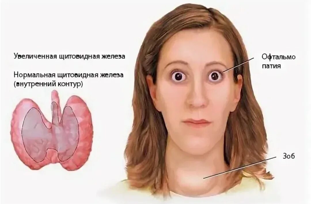 Щитовидная железа базедова болезнь. Диффузный токсический зоб( болезнь Грейвса-базедова). Гиперфункция щитовидной железы зоб базедова болезнь. Тиреотоксикоз щитовидной железы зоб. Почему увеличивается глаза