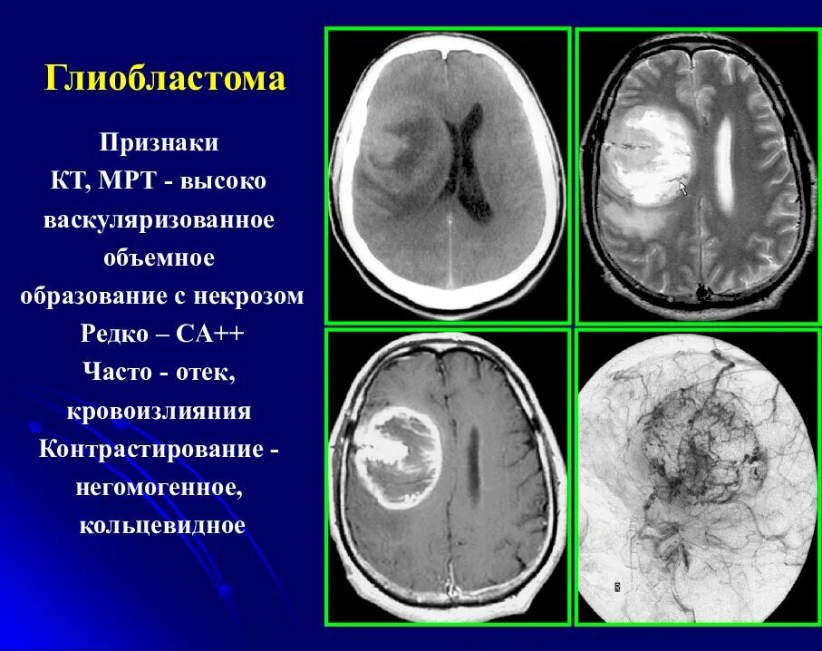 Клинические симптомы опухоли головного мозга. Объемное образование головного мозга. Опухоль головного мозга симптомы у детей. Опухоли мозга у подростков