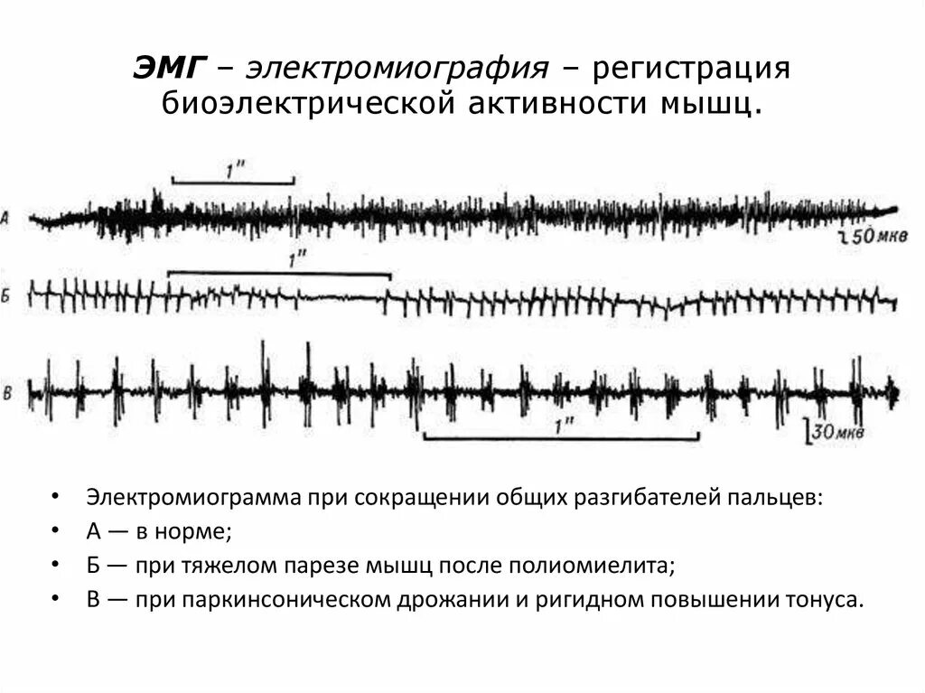 ЭМГ исследования нормы. Электромиография расшифровка электромиограммы. Поверхностная ЭМГ расшифровка. ЭМГ игольчатая норма.