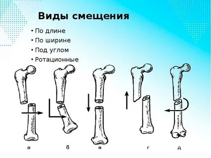 Переломы по психосоматике