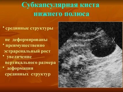 Подкапсульное образование печени