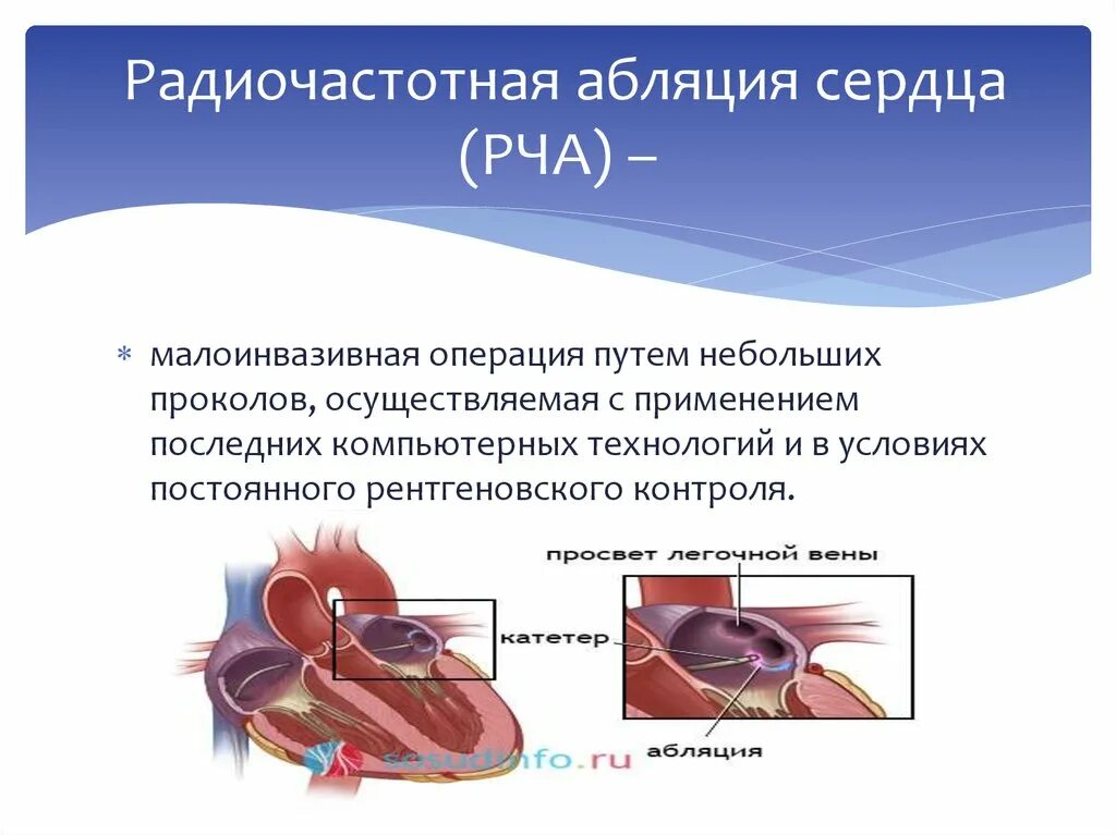 Радиочастотная катетерная абляция (РЧА). Ход операции радиочастотной абляции. Фибрилляция предсердий операция прижигание. Радиочастотная катетерная абляция методика проведения.