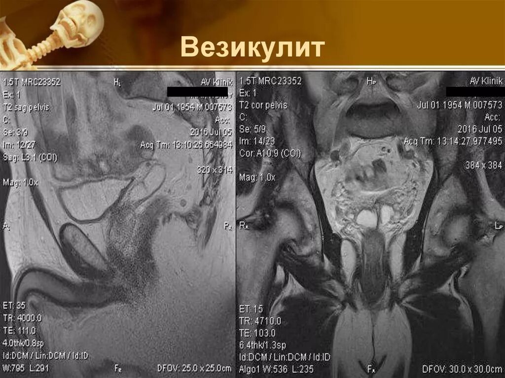 Везикулит у мужчин симптомы. Хронический везикулит мрт.