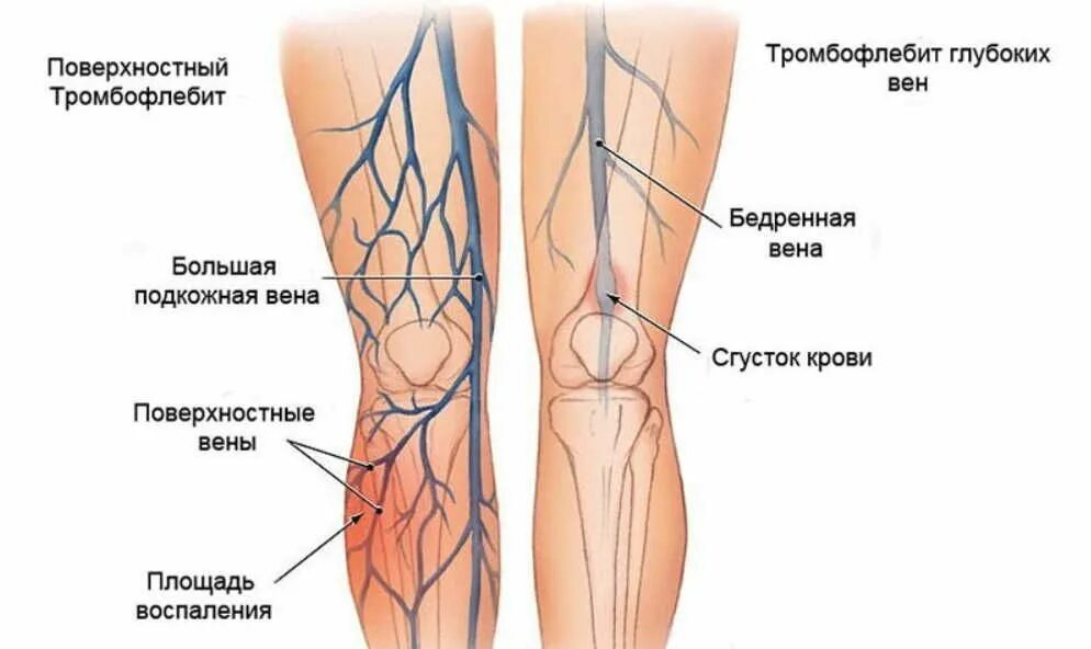 Варикозное расширение вен нижних конечностей, тромбофлебит. Тромбофлебит вены голени. Тромбофлебит поверхностных и глубоких вен. Тромбофлебит подкожных вен. Став тромбы